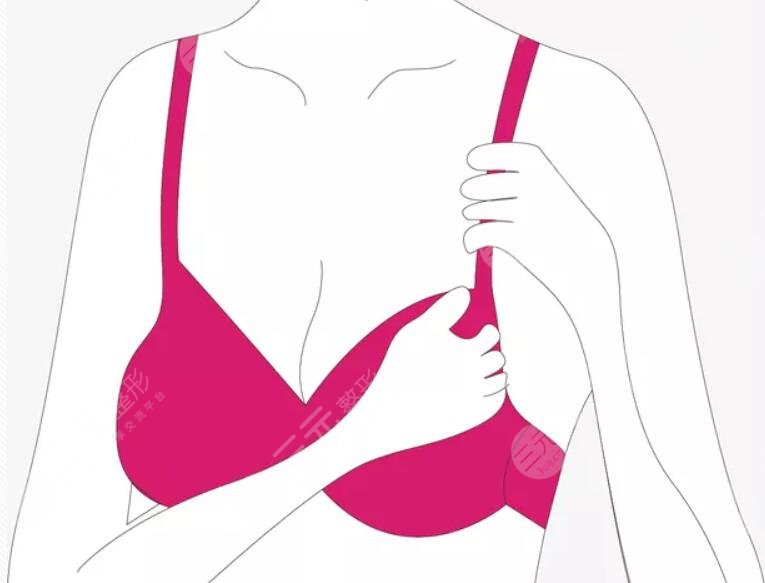 广州天姿医疗美容医院自体脂肪隆胸过程图——汪海滨医生